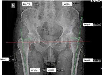 Corrigendum: Accuracy of the Horizontal Calibrator in Correcting Leg Length and Restoring Femoral Offset in Total Hip Arthroplasty